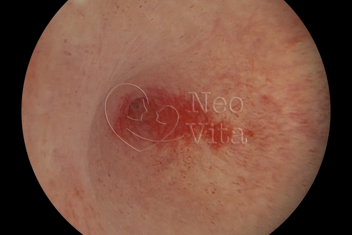histeroscopia cirurgica histeroscopia diagnostica