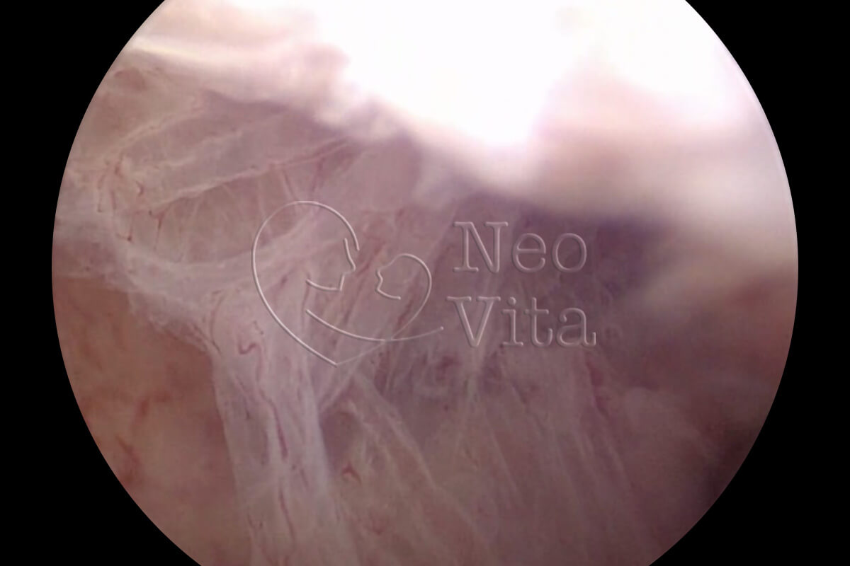 histeroscopia cirurgica histeroscopia diagnostica