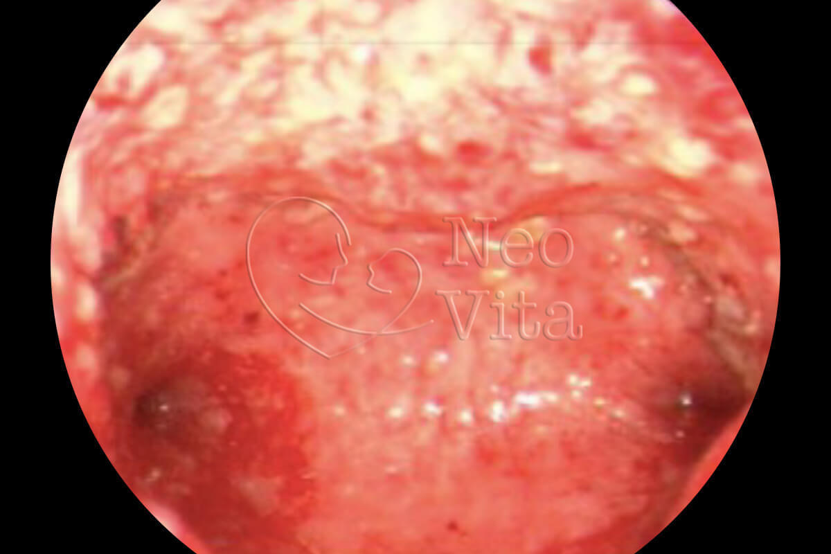 histeroscopia cirurgica histeroscopia diagnostica