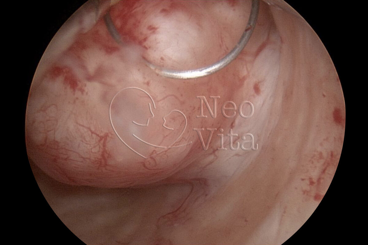 histeroscopia cirurgica histeroscopia diagnostica