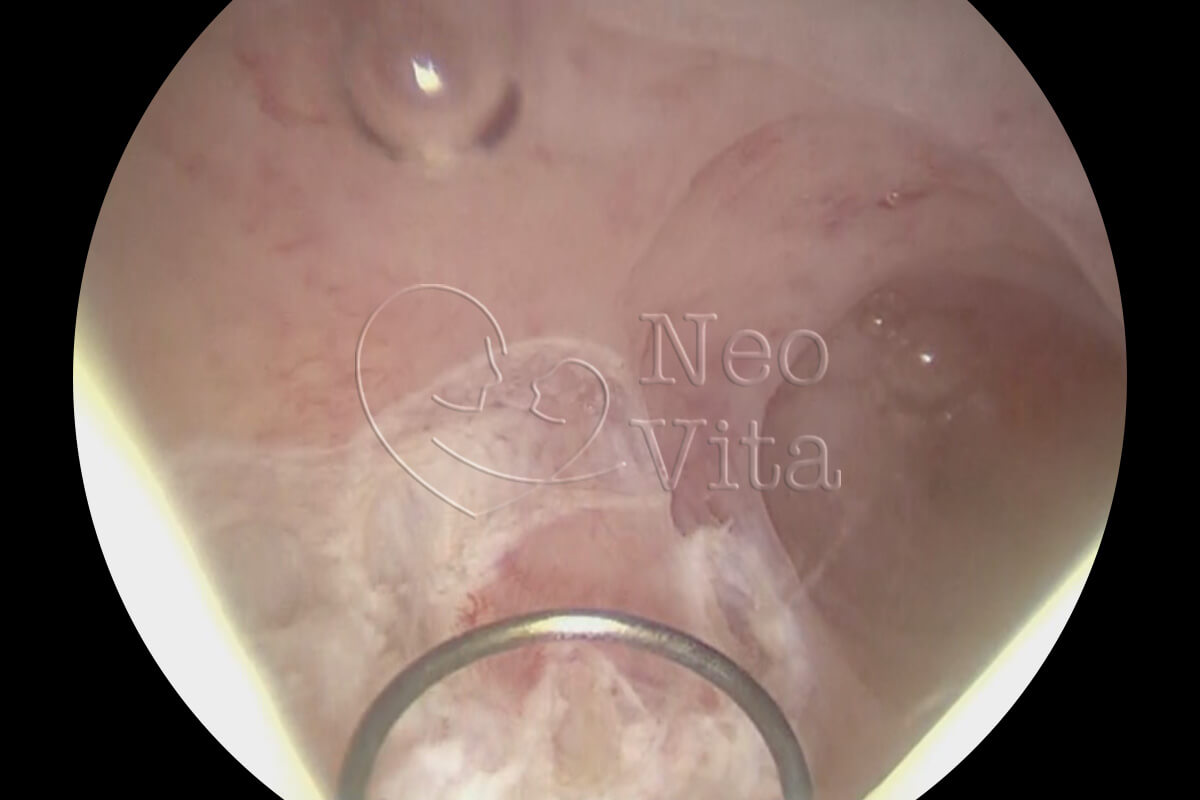 histeroscopia cirurgica histeroscopia diagnostica