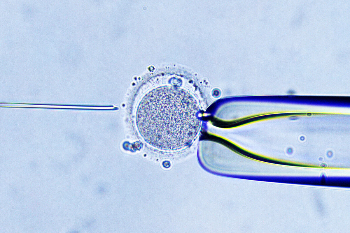 ICSI - Injeção intracitoplasmática de espermatozoide