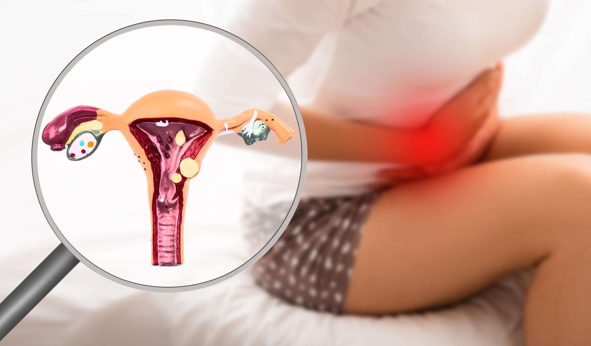 Conheça os principais sintomas da endometriose profunda