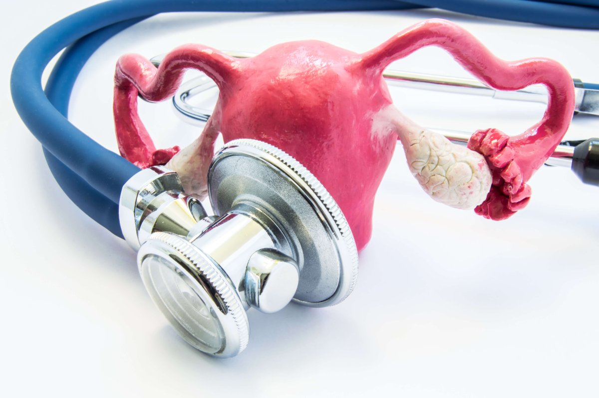 Fiv com hidrossalpinge: o líquido pode atrapalhar o processo de fertilização?