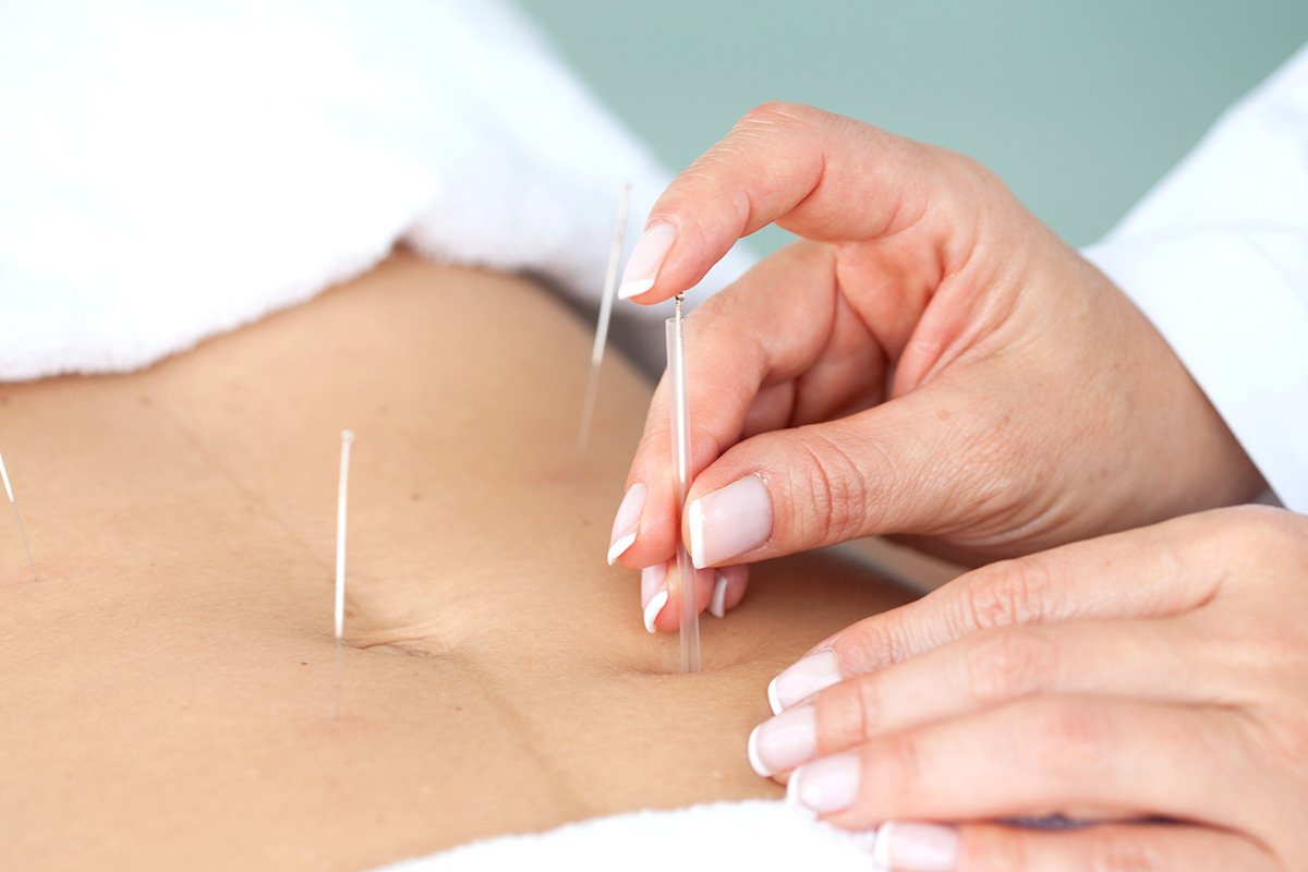 Para desobstruir as trompas: entenda como a acupuntura pode ajudar a fertilidade
