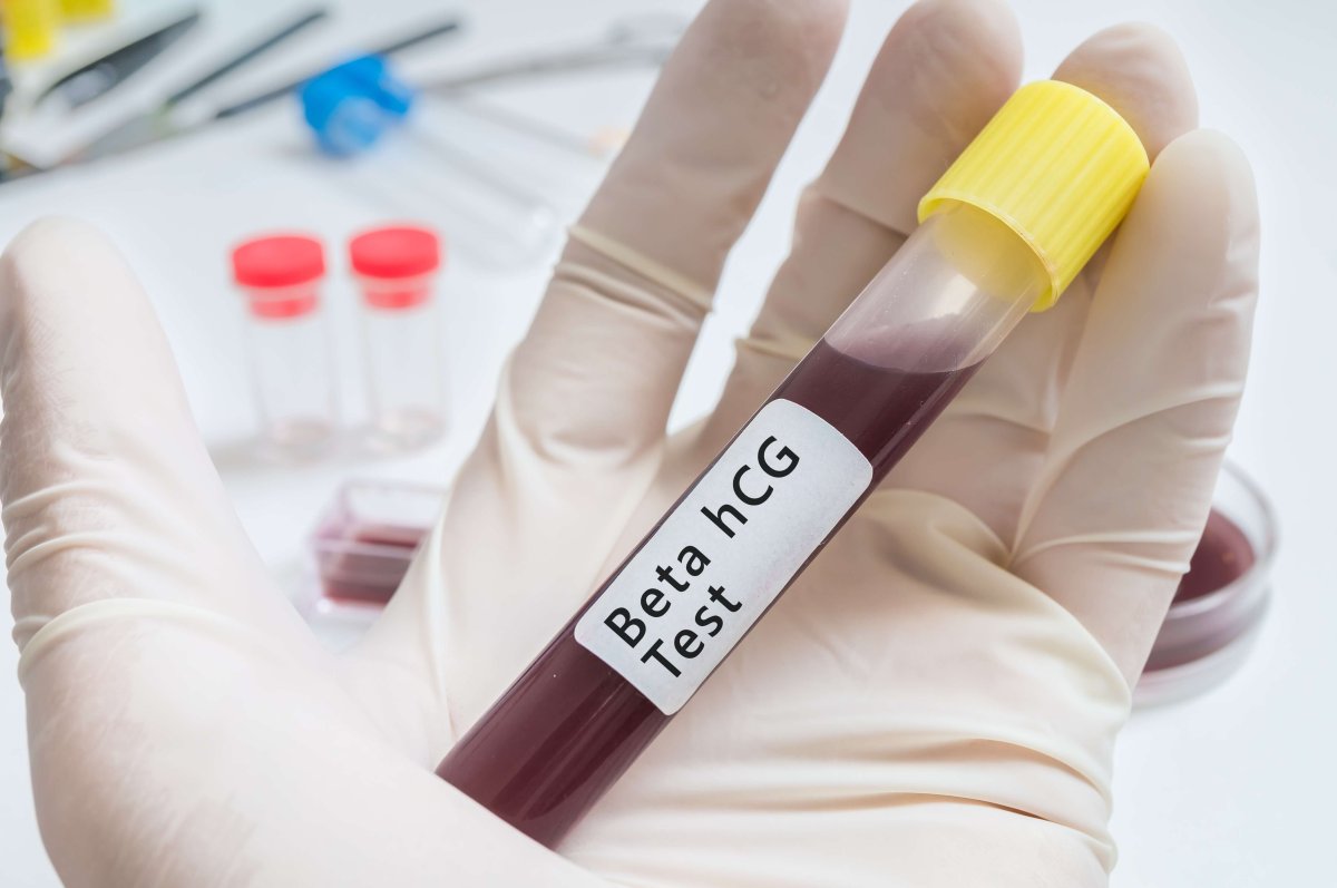 Exame beta-hcg: descubra como funciona