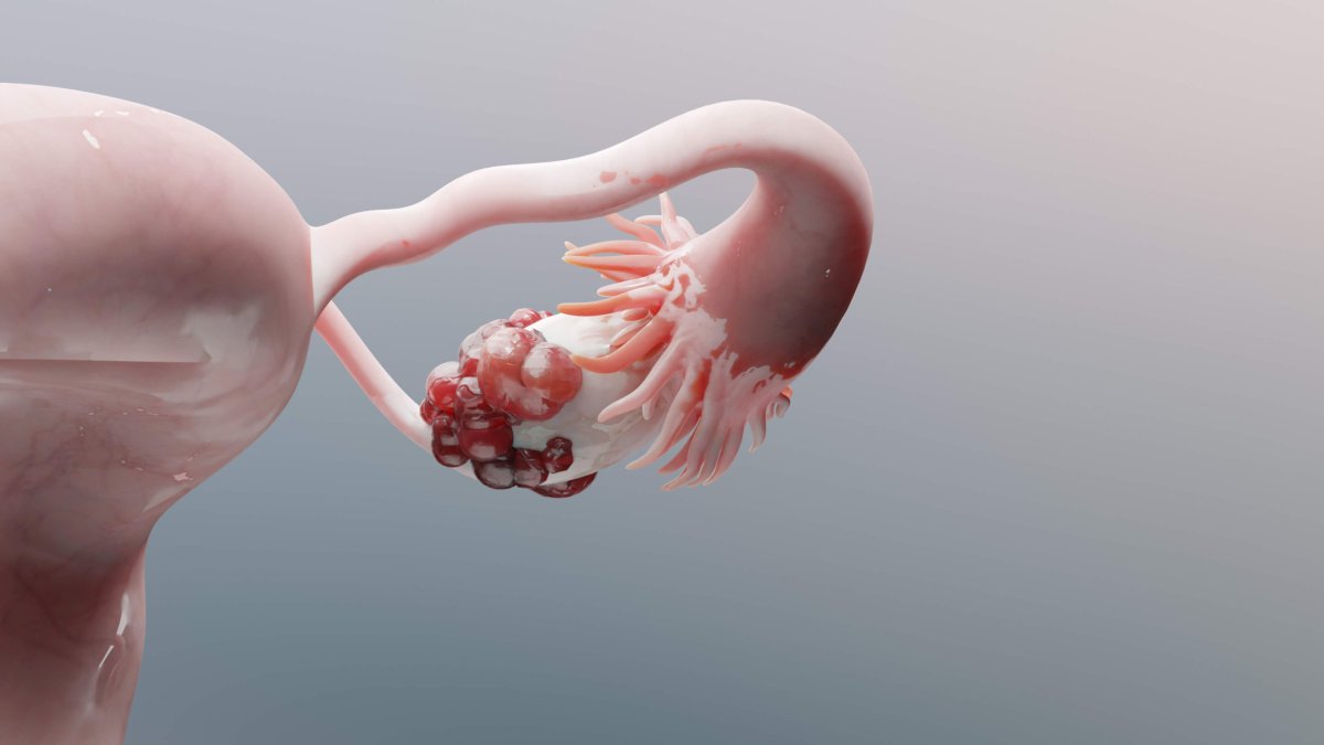 Endometriose: presença de endometrioma