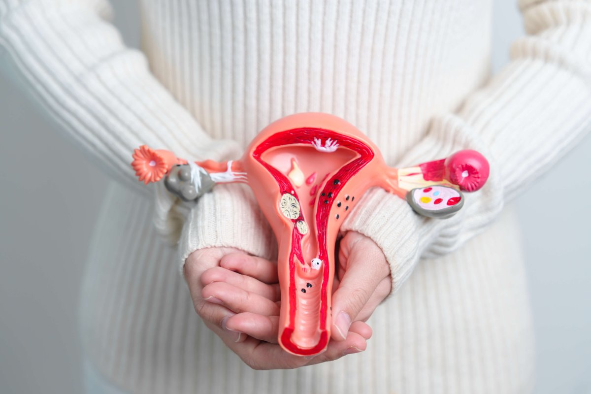 Entenda a relação entre endometriose e infertilidade