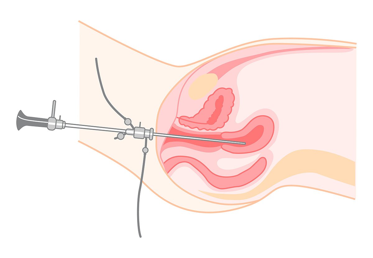 Histeroscopia diagnóstica