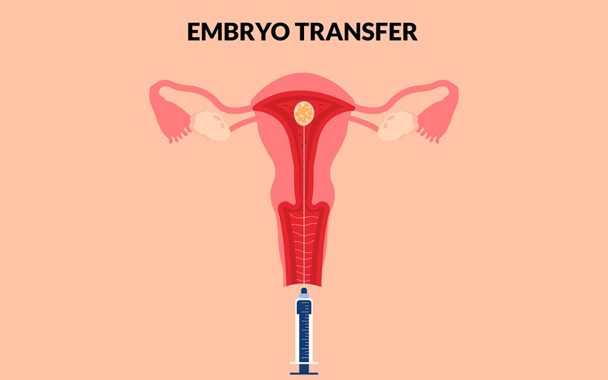  Transferência de embriões descongelados