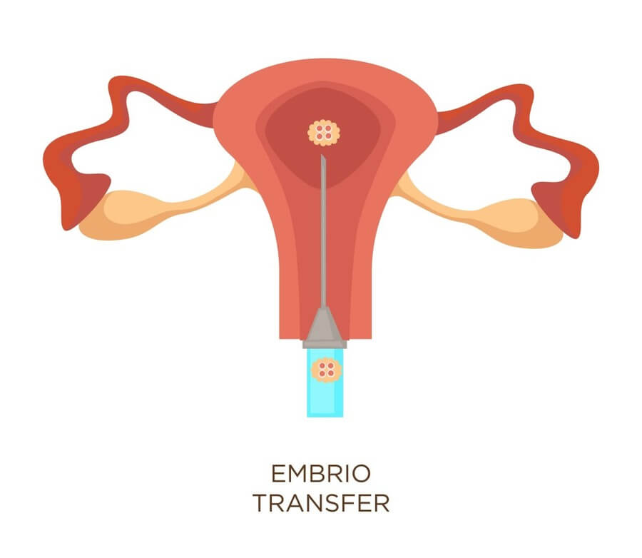 Transferência de embriões descongelados aumenta a chance da FIV