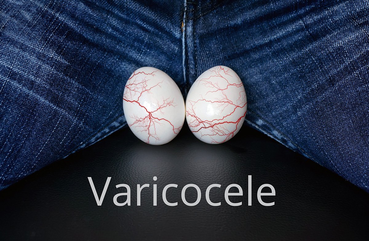 Varicocele: sintomas da maior causa de infertilidade masculina